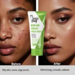 Hyper Beauty Acne and Pimples Facial Wash - Image 3